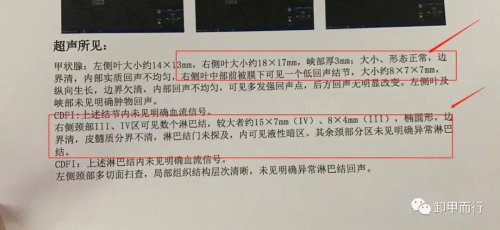 6-04:中上极甲状腺癌侧颈淋巴结转移,非偶发事件