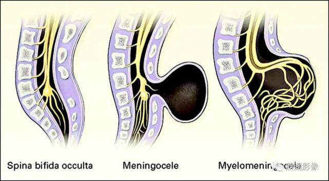 骶椎裂有显性和隐性两种;其中骶椎隐裂(spina bifida occulta)较多见