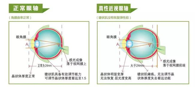 眼轴说了算