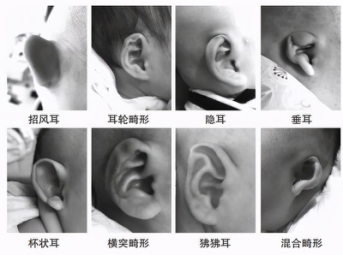 招风耳也是畸形的一种新生儿耳廓畸形矫正宜早不宜迟