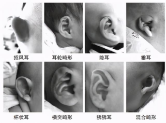 "招风耳"也是畸形的一种!新生儿耳廓畸形矫正宜早不宜