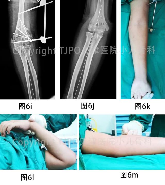 tjpo儿童矫形科普系列(4)——陈旧肱骨外髁骨折致肘