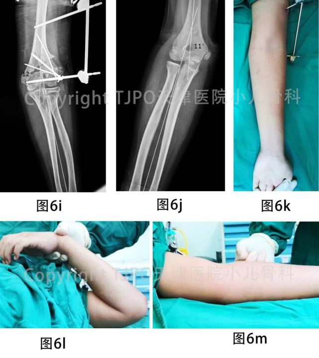 tjpo儿童矫形科普系列(4—陈旧肱骨外髁骨折致肘外翻畸形矫正