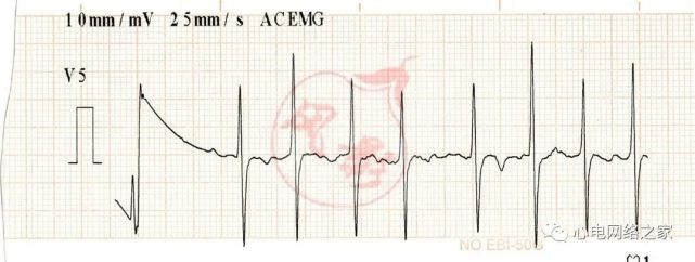 心电图知识25:右位心