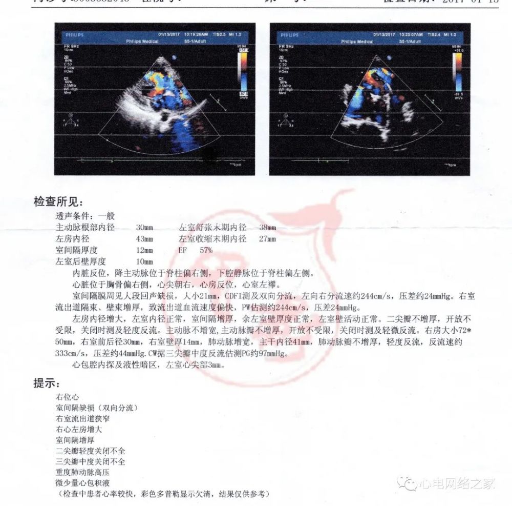 心电图知识25:右位心