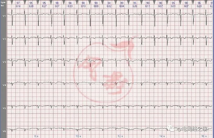 心电图知识25右位心