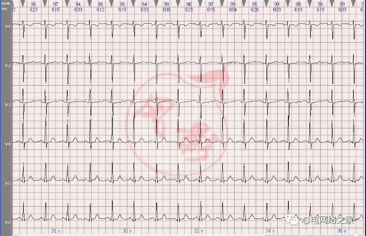 心电图知识25:右位心