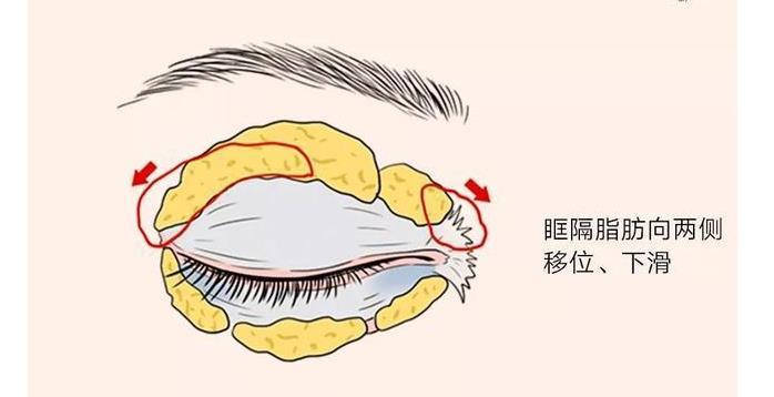 早晨起床后变成肿眼泡有5个原因还请逐一排查