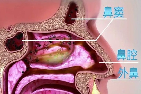 鼻窦囊肿包括那些类型