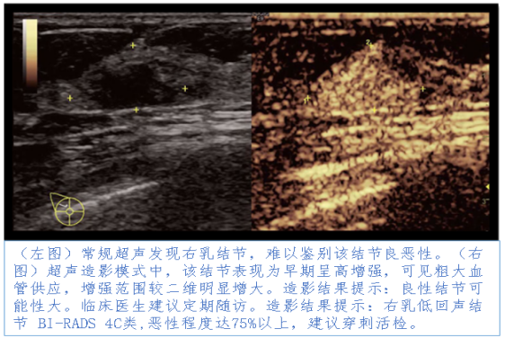 乳腺癌发病率逐年攀升,快来简医做个乳腺超声造影检查!|健康科普