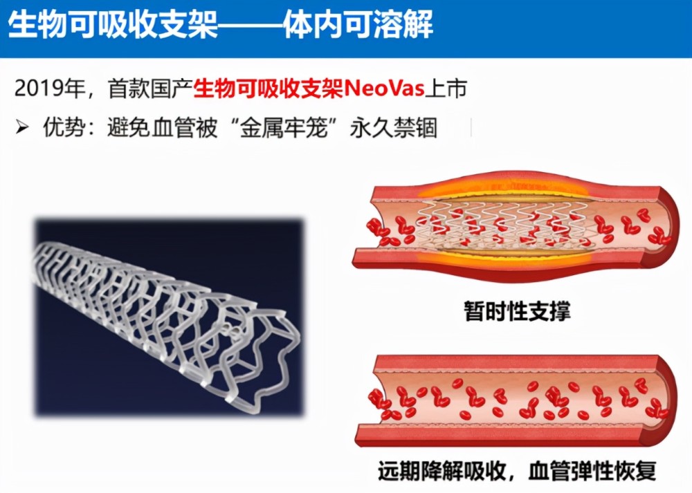 冠脉介入治疗新趋势:可降解支架,让患者不再"堵心"