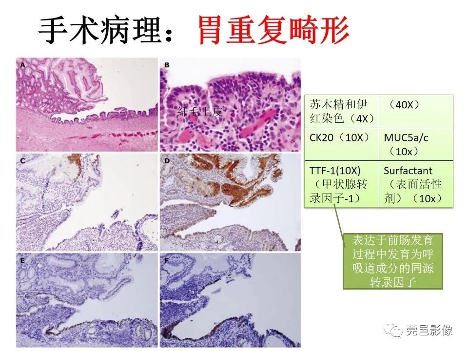 多位于粘膜下层,与正常胃壁共有平滑肌层或浆膜层;内衬黏膜产生特征性