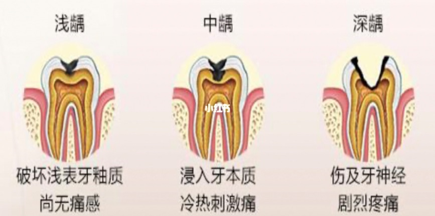 后期症状:一般龋洞比较大,龋损已达到牙本质深层,用牙科医生的探针或