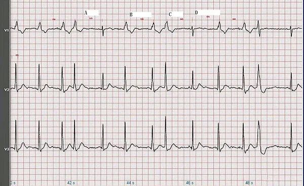 心电图讲解,心电图怎么看