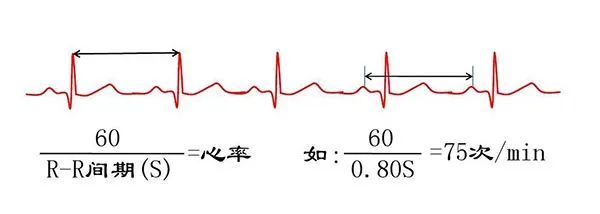 病人常要来问这个心律不齐是怎么回事,如果心电图除不齐外其他均正常