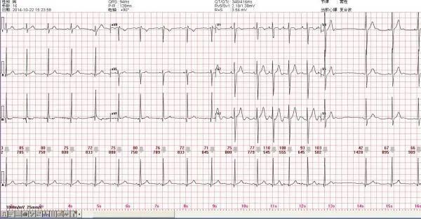 心电图讲解,心电图怎么看