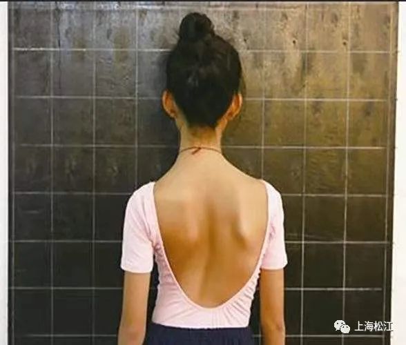 如何自我检测脊柱侧弯,松江医生来教你