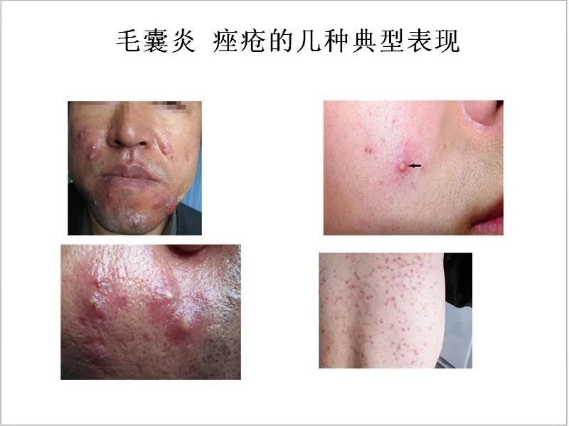 【肤康·科普】毛囊炎和痤疮搞不清,按照这些特征分一