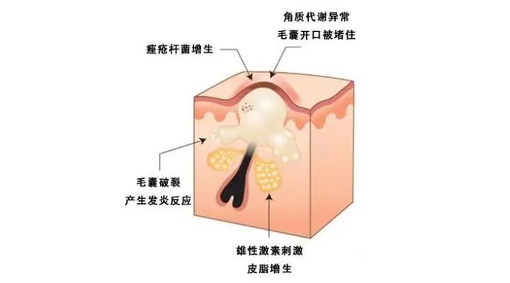 而痤疮属于白头或黑头粉刺,脱落后会有黑色素沉积,还可能在皮肤上留下