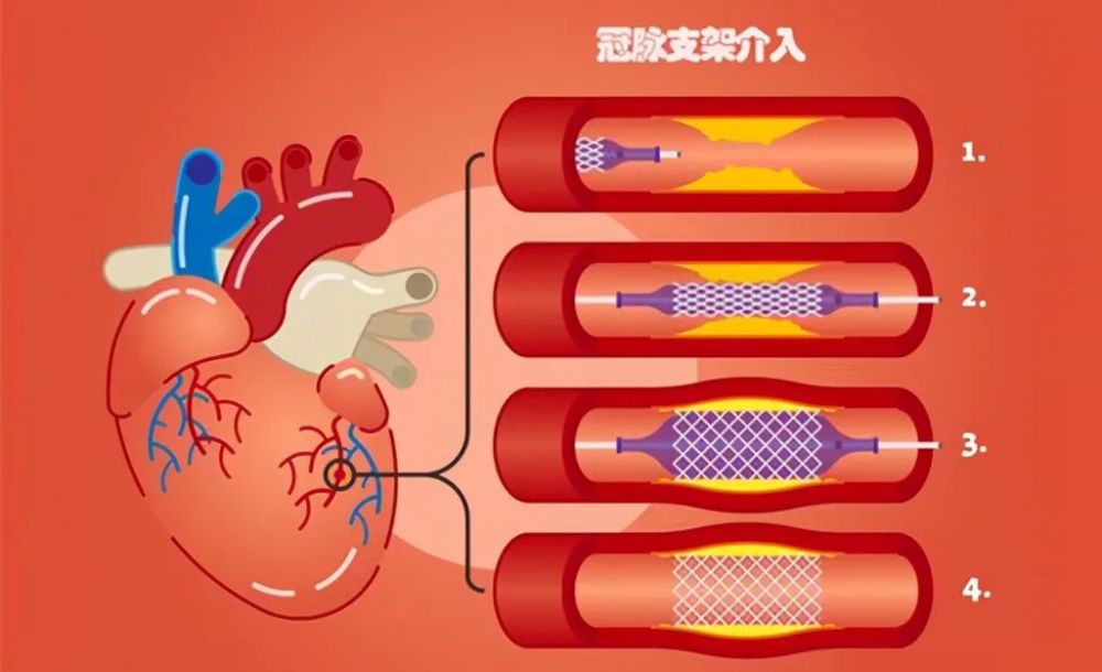 放了心脏支架担心会有副作用能不能够延长寿命