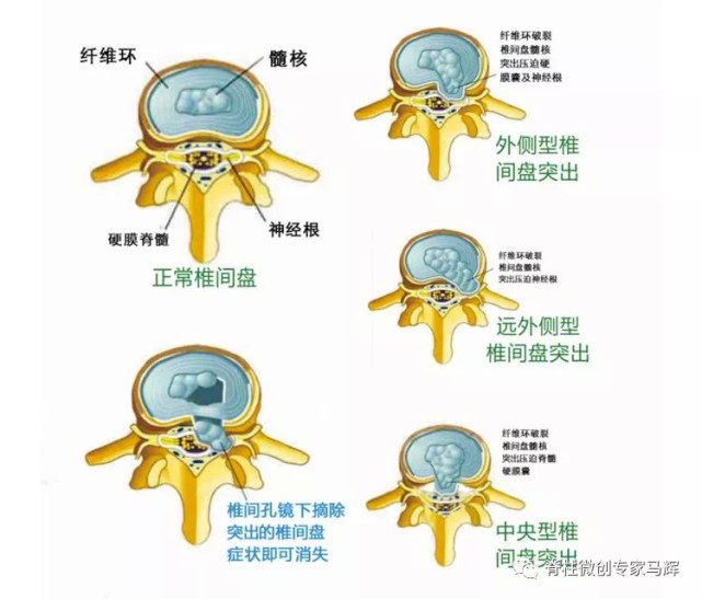 腰椎间盘突出的分型辨治