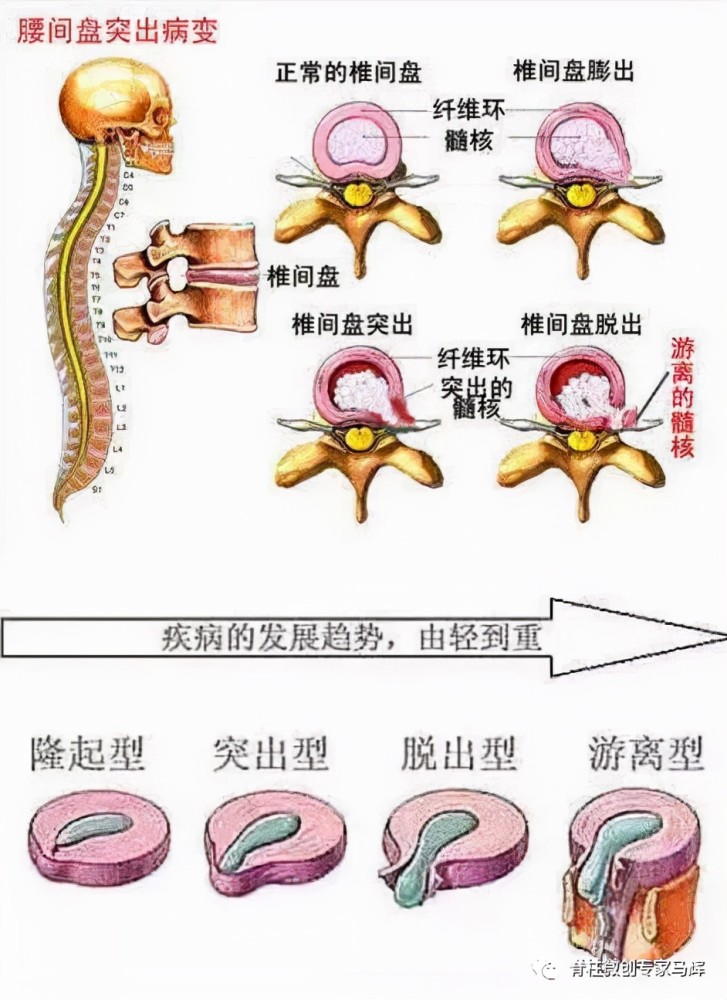 完成椎间盘髓核摘除,骨赘清除,神经根松解,椎管及椎间孔减压等,从而