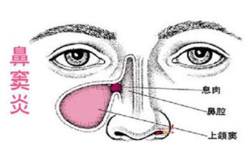 南昌博大耳鼻咽喉医院鼻窦炎最典型的4大症状