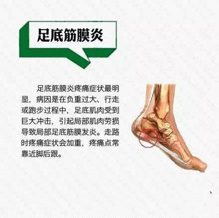 足底筋膜炎常表现为脚跟的疼痛和不适, 一般早上起床时疼痛感觉明显