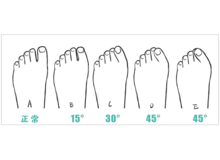 在穿鞋时大拇趾受到挤压,所以此脚型最易患拇外翻;正常人脚的形