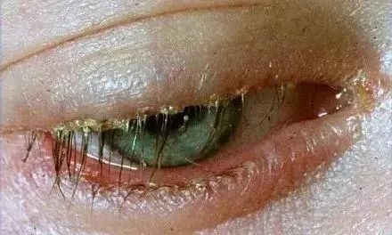 "烂眼边.