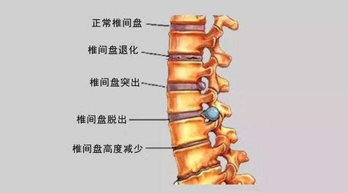 纤维环及软骨板,尤其是髓核,有不同程度的退行性改变后,在外力因素的