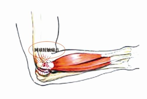 什么是网球肘如何自我保健