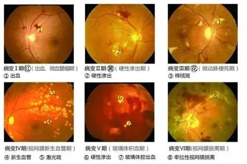 眼底病严重可致盲,征集1000人限定免费眼底拍照!