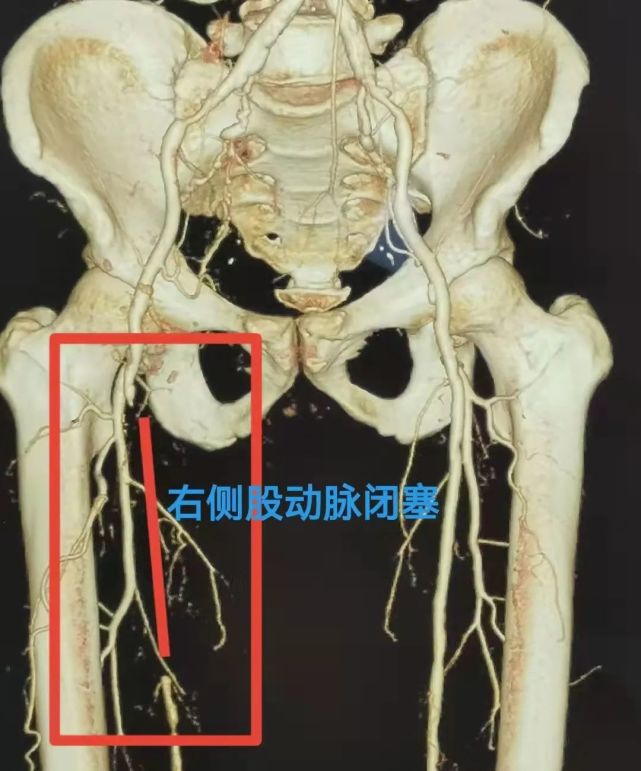 行双下肢彩超发现右侧股浅动脉上段及中段管腔闭塞,右侧髂外动脉重度