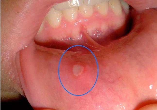 口腔溃疡就是指在 宝宝的口腔内唇,上颚,舌颊等部分黏膜上形成的圆形