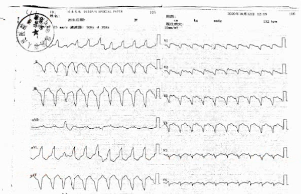 结合该患者患者窦性心律心电图所见的ε波,考虑诊断为致心律失常右室
