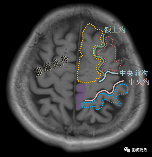 为了保证文章内容的准确性,本文对所有脑沟,脑回的解剖特征进行描述