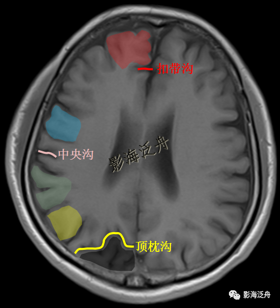 区域,中央沟(粉色线条,缘上回(绿色区域,角回(黄色区域,顶枕沟