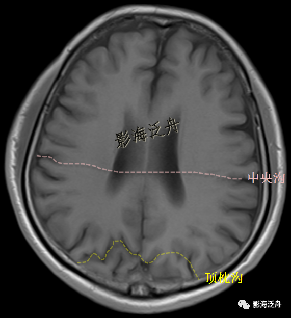 侧脑室顶部附近层面上,胼胝体后方最深的一条脑沟,该沟前方为楔前叶