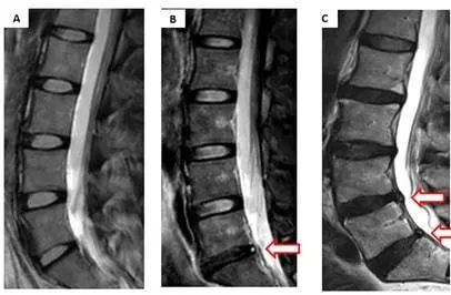 腰椎磁共振:箭头所指处为椎间盘hiz征