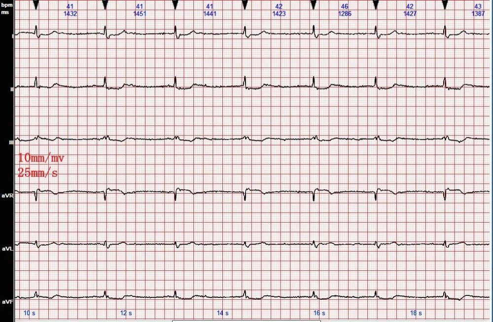 心电图病例分析1:三度房室传导阻滞,交界性逸搏心