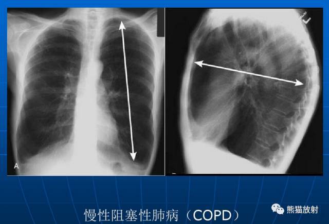 【x线诊断要点】关于"肺气肿"的一些概念,需要熟悉(ct