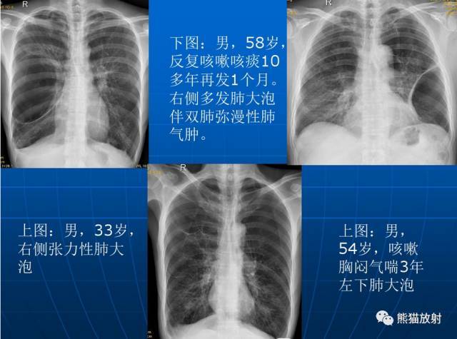 x线诊断要点关于肺气肿的一些概念需要熟悉结合ct