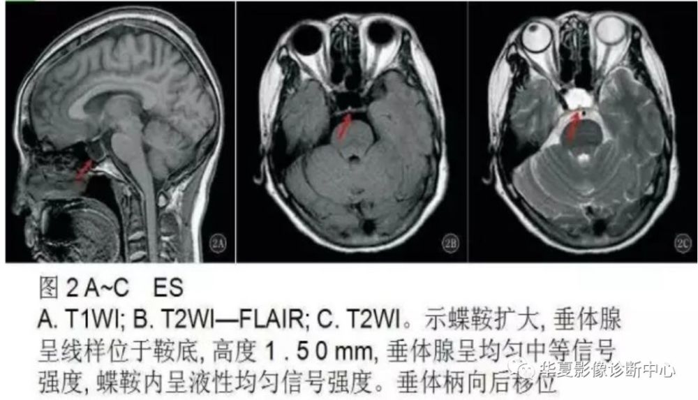 空泡蝶鞍综合症的影像表现及诊断