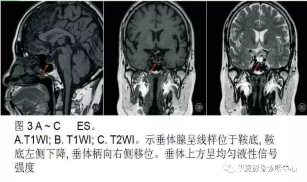 空泡蝶鞍综合症的影像表现及诊断