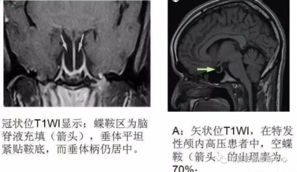 空泡蝶鞍综合症的影像表现及诊断