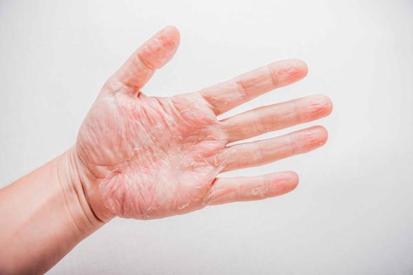 冬天双手易脱皮,是太干燥了吗?若不是皮肤缺水,警惕皮肤病