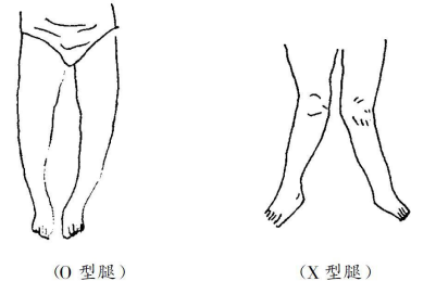 孩子o型腿和x型腿不可轻视要学会判断