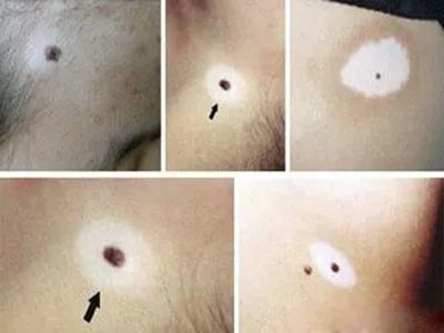 晕痣能自愈吗合肥华夏白癜风医院治疗晕痣有效吗