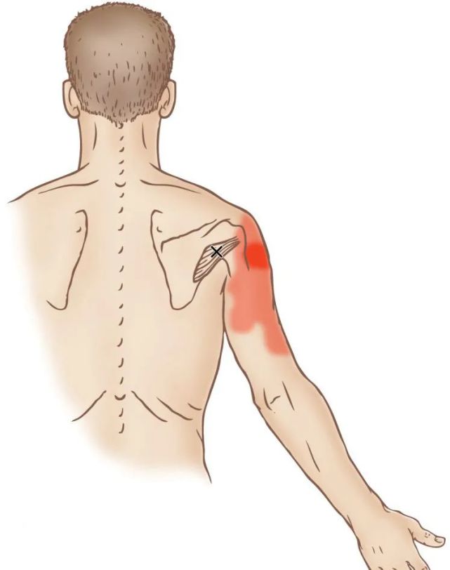15个与上胸部,内脏和上肢疼痛的肌肉
